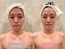 ドレッサー 福岡香椎店(DRESSER)/【症例】小顔コルギ1回の結果
