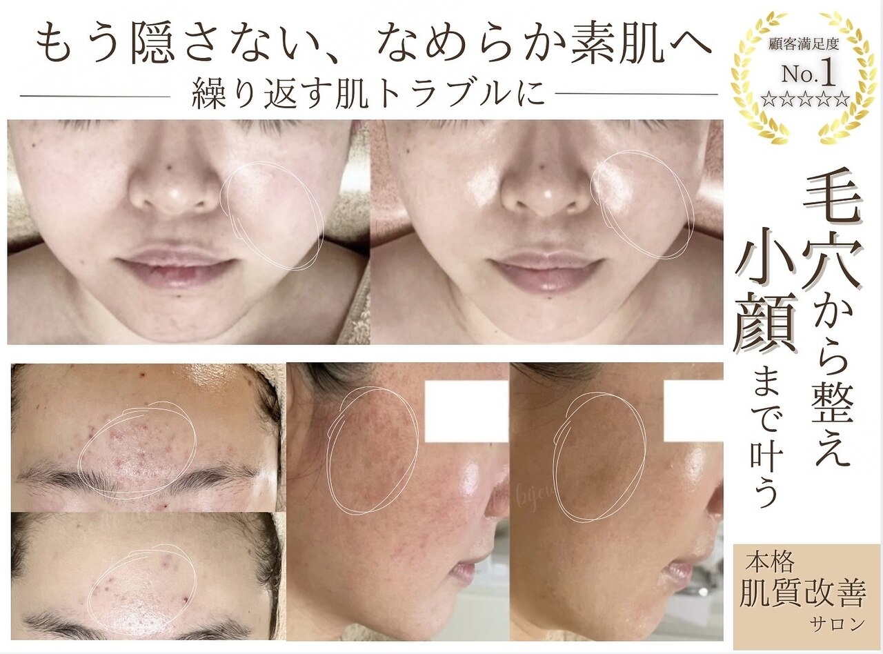 ☆大幅値下げ☆　bijou　毛穴洗浄 ソワンドビジュー(soin de bijew)｜ホットペッパービューティー
