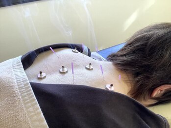 泉町鍼灸整骨院/鍼灸療法