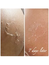 チップ(chip)/BODY（お尻）