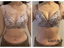 リール 新宿店(RIRE)/40代後半　バストアップ症例