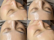 リル 和歌山市店(lilou)/圧倒的ツヤ！韓国肌管理セット！