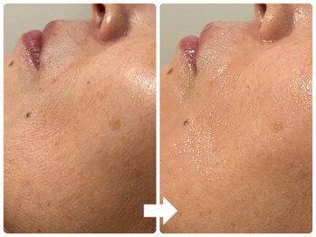 サロン ド ジョワ(salon de joie)/ハリ艶肌で小シワ改善