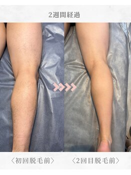 エール(AEELE)/■足まるごと脱毛■