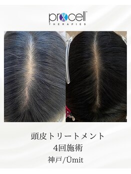 ユミト(Umit)/プロセルスカルプ