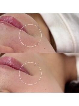 モナ(MoNa)/お顔パーツWAX脱毛