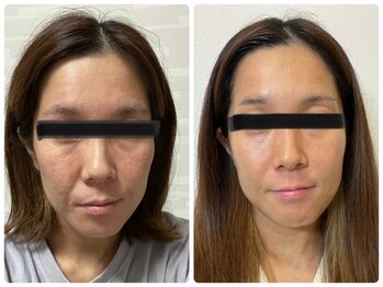 メリンダ(Merinda)/肌質改善！