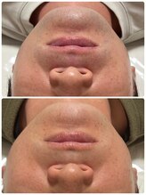 プリュボーテ(Pul Beaute)/メンズ髭脱毛