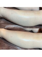 ゴールデンエイジ 吉祥寺(GOLDEN AGE)/ワックス脱毛 : 施術