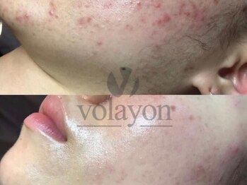 グレイスリリー(grace lily)/