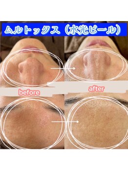 エムアイ 六本木(Mi)/メンズスキンケア