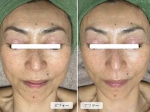 スローガーデン(Slow Garden)/ヒト幹細胞×炭酸パック1回