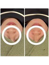 ソルニス(Solnis.)/【お鼻】脂肪撃退◎　お鼻　1回