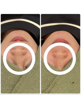 ソルニス(Solnis.)/【お鼻】脂肪撃退◎　お鼻　1回