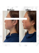 ザビューティー 麻布十番本店(The Beauty)/12Dリフト全顔打ち放題[リフト]