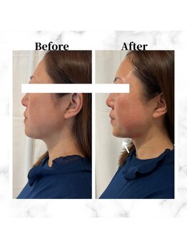 ザビューティー 麻布十番本店(The Beauty)/12Dリフト全顔打ち放題[リフト]