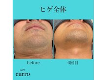 アクト クロ(ACT curro)/【ヒゲ全体】脱毛施術例