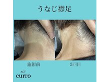 アクト クロ(ACT curro)/【うなじ襟足】脱毛施術例