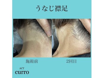 アクト クロ(ACT curro)/【うなじ襟足】脱毛施術例