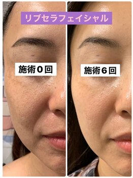 プリュネル(Prunelle)/プラズマシャワー