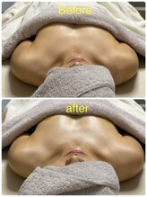 ベッピン(Beppin)/バストの左右差/産後ケア/筋膜