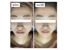 ホワイトアクア つくば店(WHITE AQUA)/ハーブピーリング/艶肌/つくば