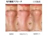 【徹底毛穴改善】REVIハーブピーリング+毛穴ケアOP+韓国毛穴洗浄¥22000→