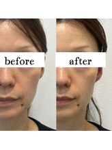 シーズボーテ(C's Beaute)/人気のハーブピーリング♪