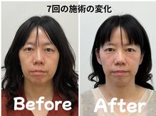 ゆず鍼灸整骨院/当院人気NO1！美容鍼モニター様