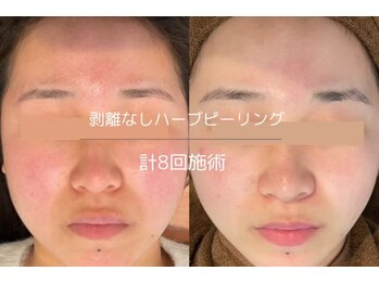 ライフサロン 別府(Life Salon)/お顔ハーブピーリング2