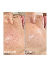 アンブル レイジュアリー(Amble leisurely)/水光肌ピーリング