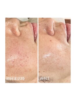 アンブル レイジュアリー(Amble leisurely)/水光肌ピーリング