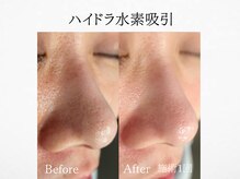 アンドミルル(and Milulu)/【ハイドラ水素吸引】