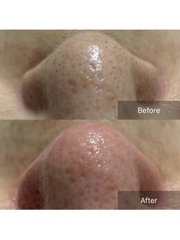 んまち/毛穴ケア