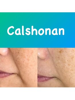 キャルショウナン バイ サンダンス(CALSHONAN by SUNDANCE)/低周波