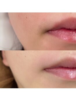 モナ(MoNa)/お顔パーツWAX脱毛