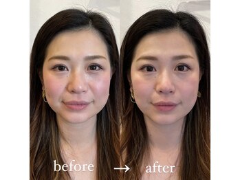 鍼グリッター 岡山本院(鍼Glitter.)/［ビフォーアフター]美容鍼