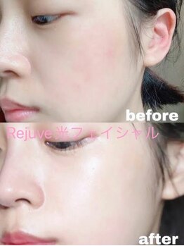 リジュベ(Rejuve)/毛穴洗浄/毛穴エステ/毛穴/美肌