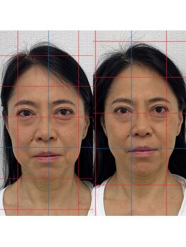 ハーモニーフィットネス 赤坂(Harmony Fitness)/お顔のたるみ歪み改善