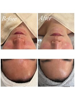 プララン 京都桂店(Plaran)/角化したお肌が柔らかく☆