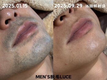 ルーチェ/【ヒゲ脱毛】8ヶ月の成果
