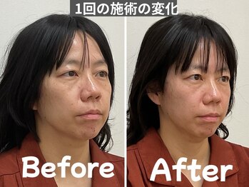 ゆず鍼灸整骨院/当院人気NO1！美容鍼モニター様