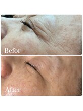 ブランカ(BLANCA)/ララピール　ビフォーアフター