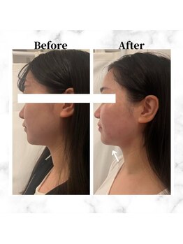 ザビューティー 麻布十番本店(The Beauty)/12Dリフト全顔打ち放題[リフト]