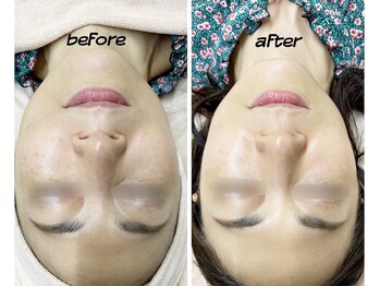 KMB 恵比寿店/光フェイシャル&炭酸ガスパック