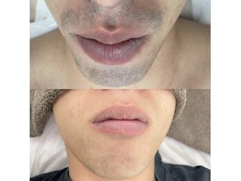 カルディエ(Cardie)/ひげ脱毛　ビフォーアフター