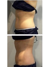 ラヴィエール(Laviere)/レディース痩身120分4回目