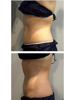 ラヴィエール(Laviere)/レディース痩身120分4回目