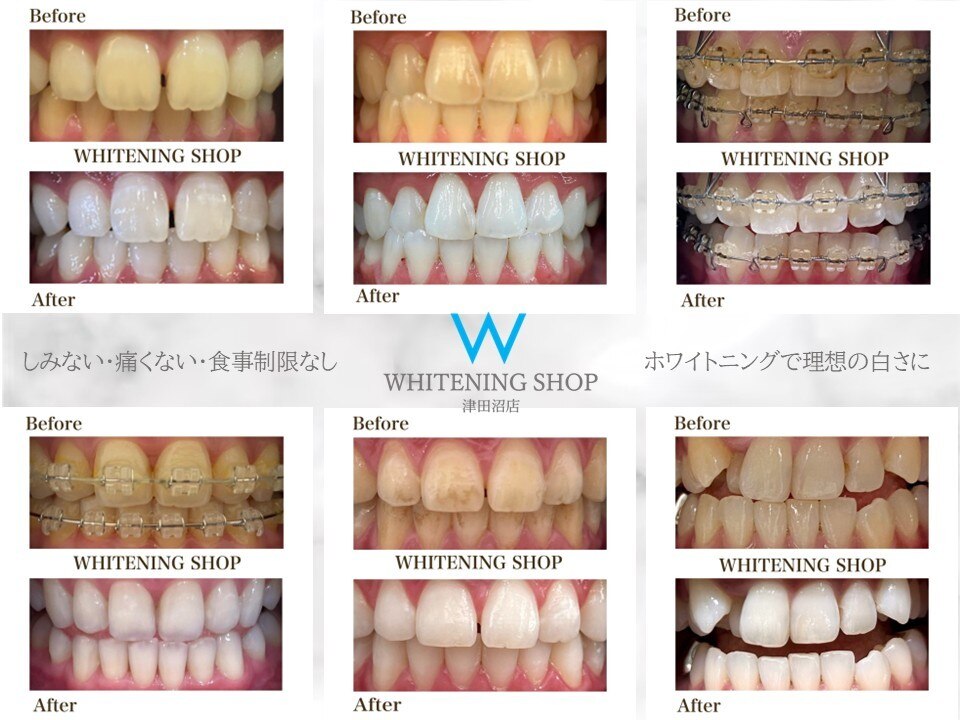 ホワイトニングショップ 津田沼店｜ホットペッパービューティー