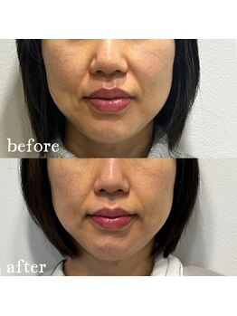 シーズボーテ(C's Beaute)/スッキリリフトアップ♪